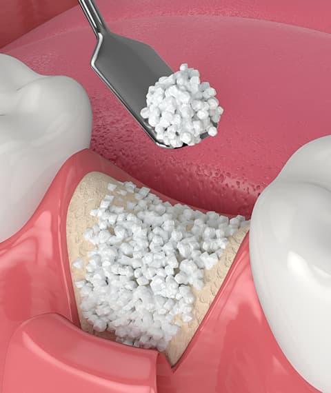 Bone Grafting for Dental Implants