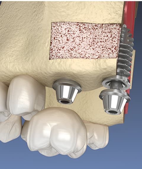 Sinus Lifts for the Upper Jaw