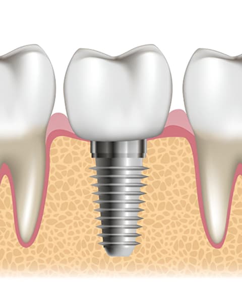 What Are Single Tooth Dental Implants?