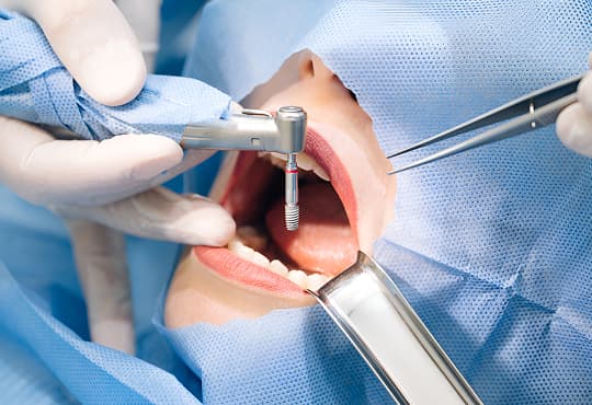 Dental Implant Surgery