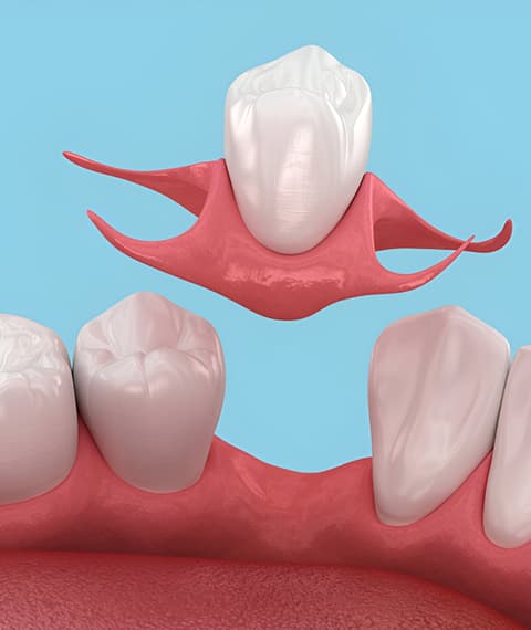 The Implant Process at Lynnhaven Dental