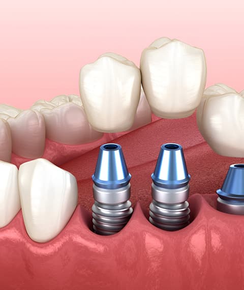 Non-Implant Tooth Replacement Options