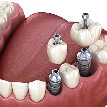 Multiple Tooth Dental Implants