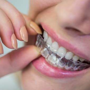 Invisalign For Crowded Teeth