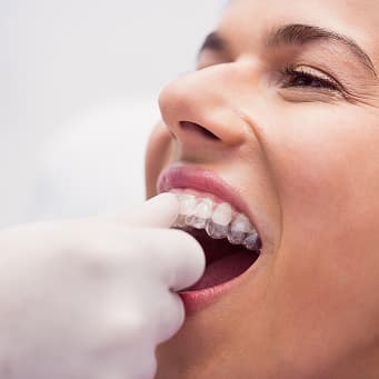 Invisalign For Spaced Teeth
