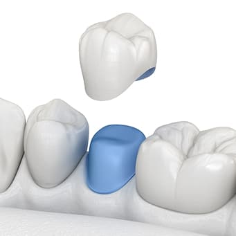 Dental Crown & Bridges